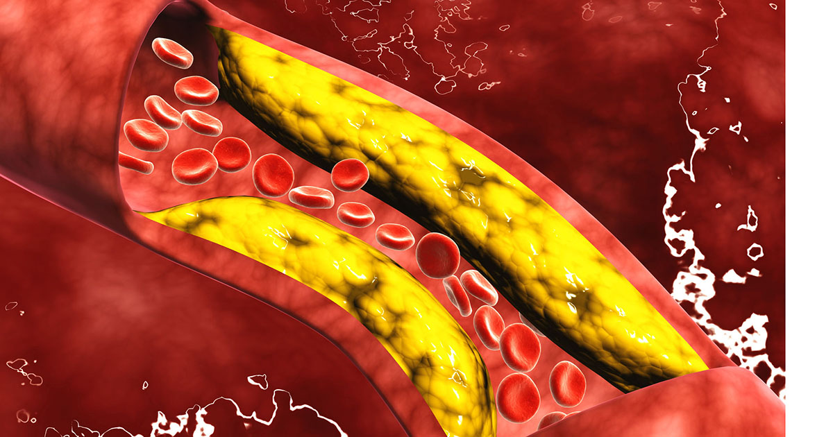 Si të ulim nivelin e kolesterolit në gjak nëpërmjet dietës ushqimore?